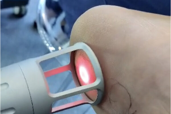 Láser de Alta Intensidad acaba con el dolor de la artrosis de rodilla