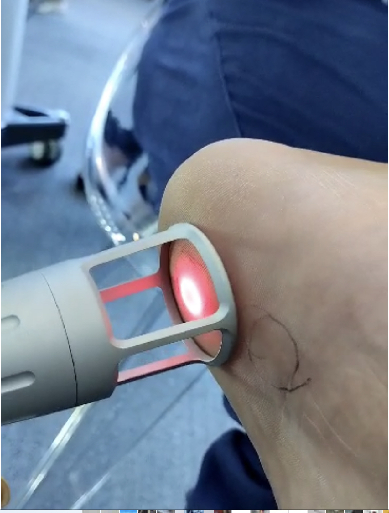 Láser de Alta Intensidad acaba con el dolor de la artrosis de rodilla